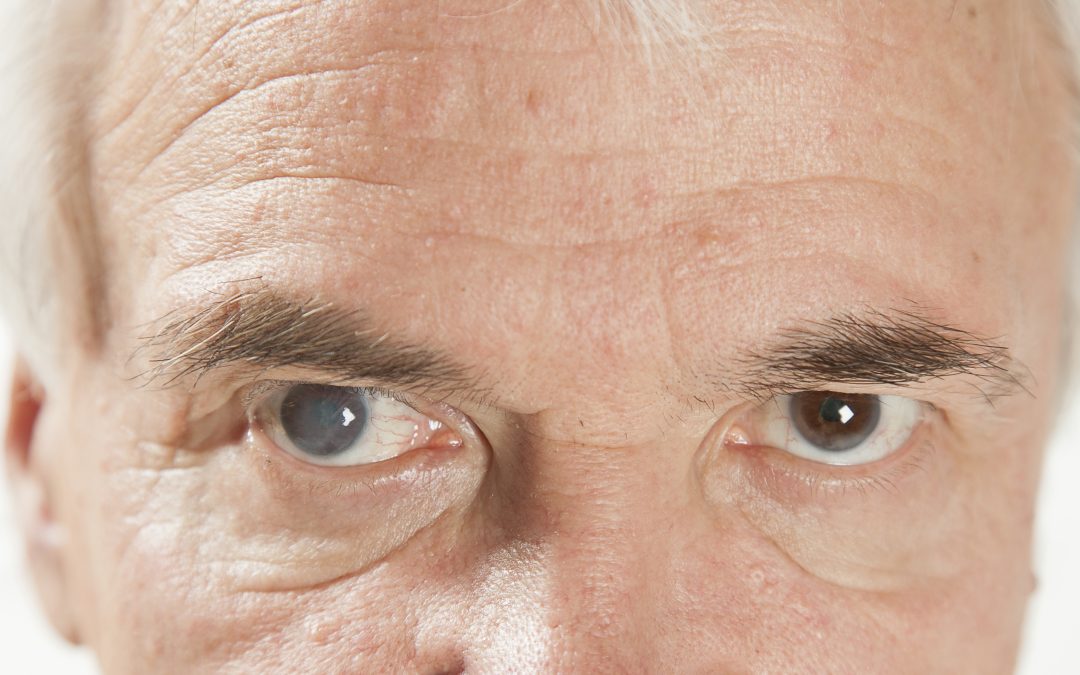 Older man with Cataracts
